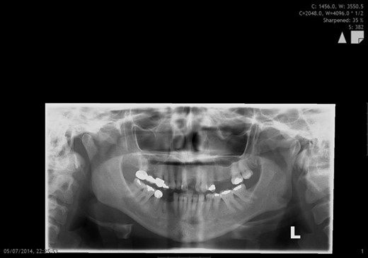 Orthopantomographic image showing a left high condylar head fracture and a stable occlusion with adequate posterior contact.
