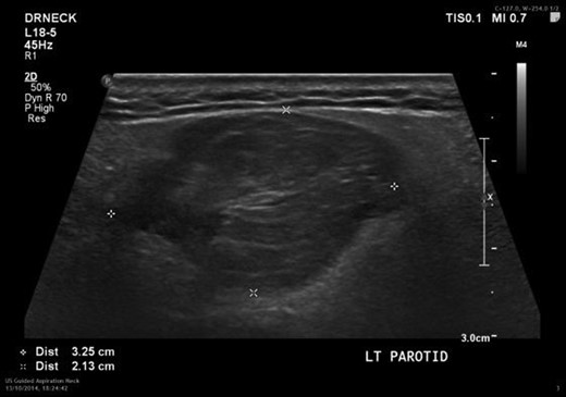 Ultrasound of the left parotid gland showing a well-circumscribed hypoechoic lesion.