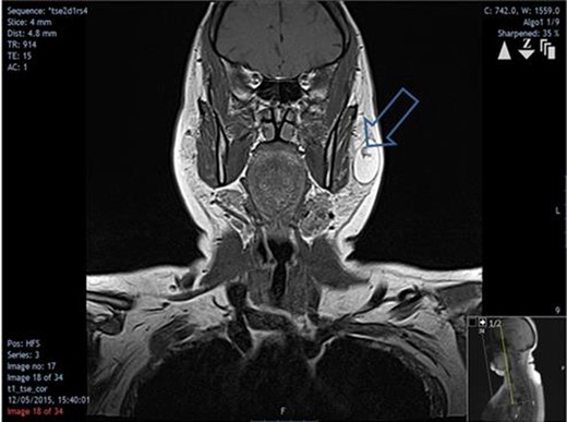 Coronal MRI showing the extent of the lipoma and vessel-like structure traversing it (arrow).