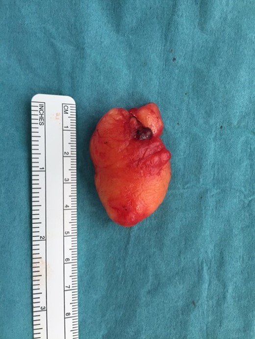 The resected parotid lipoma enclosed within a thin fibrous capsule.