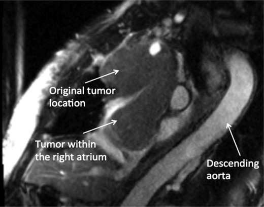 CMR sagittal view: large anterior mediastinal mass with extension into the right atrium.