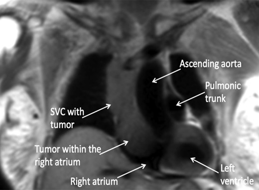CMR coronal view: anterior mediastinal mass invading superior vena cava and extending into the right atrium.