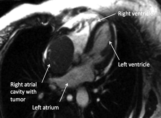 CMR axial four-chamber view: mass in the right atrial cavity protruding through the tricuspid valve into the right ventricle.