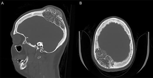 CT bone window with sagittal (A) and axial (B) views provided. A large right parietal calvarial mass expanding into the diploic space and exerting mass effect on the right parietal lobe is demonstrated.