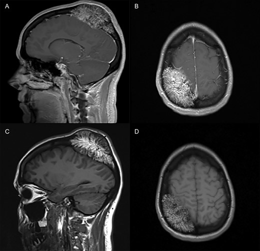T1-weighted magnetic resonance with sagittal (A) and axial (B) views provided. Imaging demonstrates the presence of an extra-axial mass expanding the calvarium and exerting mass effect on the right parietal lobe without the presence of aggressive destruction. The mass does not demonstrate contrast-enhancement as noted in sagittal (C) and axial (D) views after contrast administration. The underlying parenchyma does not demonstrate any reactive signal changes.