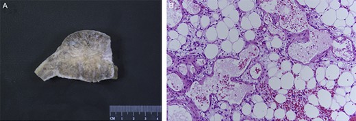 Gross (A) and microscopic specimens (B). The gross lesion was well demarcated and circumscribed. On microscopic analysis, multiple blood vessels were interspersed among the adipose tissue.