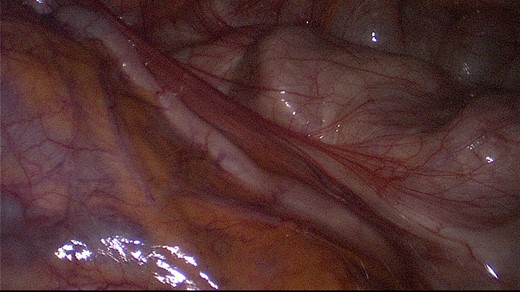 Inconspicuous appendix during first laparoscopy.