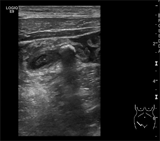 Ultrasonography showing the appendicolith and periappendiceal fluids. (Picture by Markus Buerge, MD)