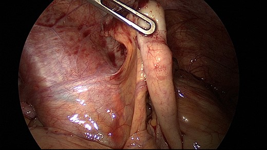 Appendicitis with local peritonitis 3 days after Fig. 1.