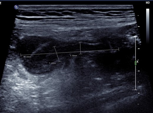 Ultrasonographic appearance of the right iliac fossa. An ill-defined hypoechoic region surrounding a tubular non-compressible structure (maximum calibre 7.15 mm) was identified. This appearance was thought most likely to represent perforated appendicitis with no definable walled-off collection.