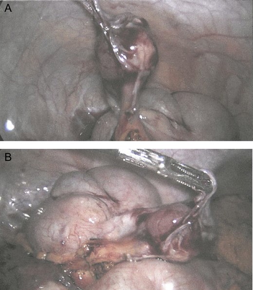 Laparoscopic appearance of the enlarged appendix tip with surrounding fibrinous adhesions and haemoserous free fluid. Appendix base is slim with normal appearance of mesoappendix. A, appendix retracted towards anterior abdominal wall; B, appendix retracted towards the pelvis.