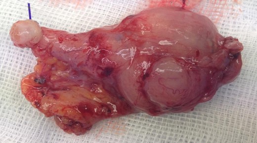 Gross appearance of the appendix following laparoscopic appendectomy. Endoloop in situ base of the appendix. Enlarged appendix tip with fibrinous adhesions lead to intraoperative suspicion of malignancy.