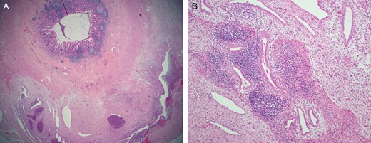 Histopathological appearance of the appendix. Haematoxylin and eosin staining. (A) Low power view of the appendix which was engulfed by and completely surrounded by the endometriosis. (B) Medium power view showing endometrial glands and decidualized stroma.