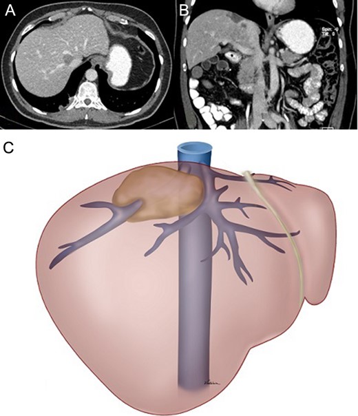 (A) and (B) Preoperative CT showing displacement of the tumour and its relationship with the right and middle hepatic veins and the IVC. (C) Schematic drawing of the tumour.