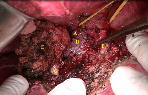 (A) Right hepatic vein sutured close to the IVC. (B) Middle hepatic vein freed from the tumour. (C) Right hepatic vein within the transected area skeletonized for 1 cm. (D) Retrohepatic IVC, area to be anastomosed to one end of the graft. (E) Segment 8 with the tumour.