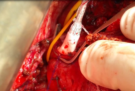 The open end of the graft being anastomosed to the IVC (the graft was previously cut to the proper length, approximately 5 cm).