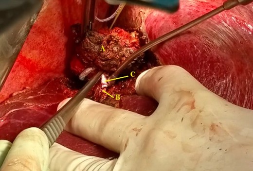 (A) Specimen, (B) right hepatic vein and (C) graft.