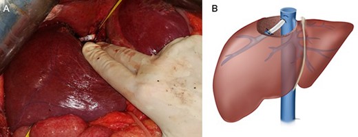 Final appearance: (A) intraoperative appearance and (B) schematic drawing.