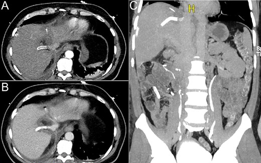 CT scan performed on the fifth post-operative day: (A) axial view, no intravenous contrast; (B) axial view, intravenous contrast inside the graft and (C) coronal view, graft filled with contrast.