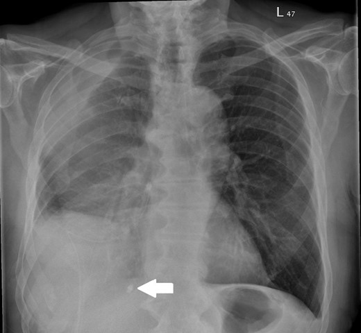 Chest radiograph demonstrating foreign body.