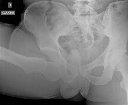 Antero-posterior radiograph showing right IHD.