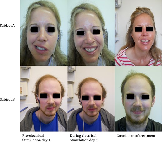 Facial symmetry of subjects performing a smile before, during and after treatment with ES.