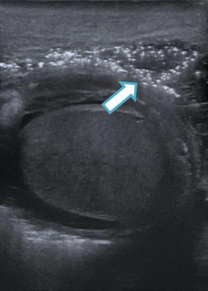 Ultrasound image demonstrating gas within the scrotum.