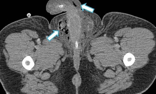 CT image (axial slice) showing gas within the scrotum and penile shaft.