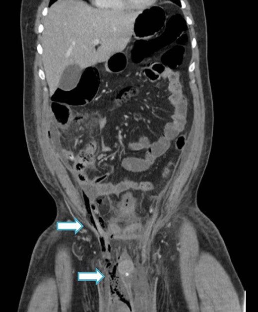 CT image (coronal slice) showing gas tracking from the right iliac fossa, down the spermatic cord into the scrotum.
