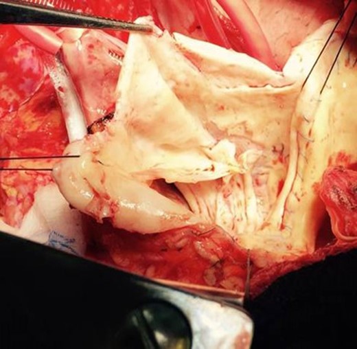 Gross image of the pulmonary autograft in the aortic valve position with significant degeneration of the valve leaflets and a dissection plane (top portion of picture) extending into the non-coronary sinus.