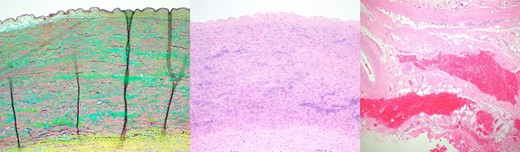 Histologic images from the dissected pulmonary autograft. Left: degradation of the media with translamellar mucoid extracellular matrix accumulation and fragmentation and/or loss of elastic fibers; middle: loss of smooth muscle nuclei with mild smooth muscle cell disorganization; right: Adventitial hemorrhage consistent with an aortic dissection is present in the lower portion of the image (Movat Pentachrome magnification, x10, H&E x10 and H&E x4).