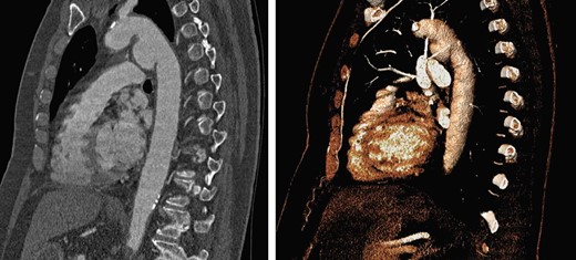 Sagittal CT with 3D reconstruction demonstrated a 39-mm saccular aneurysm along the lesser curvature of the aortic arch, expanding in the direction of the pulmonary artery.