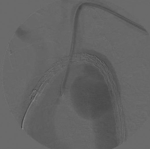Digital subtraction angiogram demonstrating the chimney-graft approach. Image acquired shortly before simultaneous subclavian and thoracic stent-graft deployment.