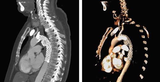 Sagittal CT with 3D reconstruction at 1-year post-intervention, showing satisfactory placement of stent grafts.