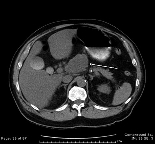 CT scan demonstrating LEC. Note the air present in the cystic mass.