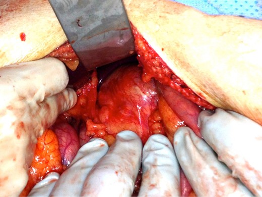 Intraoperative view of the LEC.