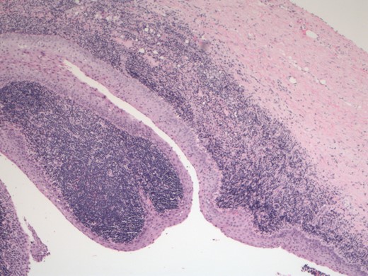 Pathology slide demonstrating characteristics of LEC.