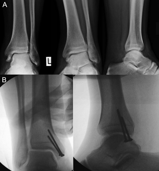 Plain radiographs of anteroposterior, mortise and lateral views revealed a fracture of the medial malleolus with no other bony injuries. A (above): before surgery, B (below): after surgery.