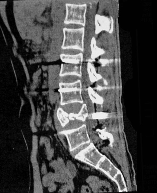 Computed tomography scan of the lumbar spine showing an L4 burst fracture.