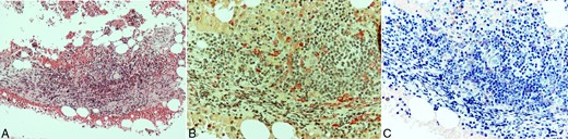 Bone marrow biopsy. Hematoxylin and eosin (H&E) stain showing nodular infiltration by lymphocytes and atypical mast cells, forming loose aggregates (A), highlighted by chloroacetate esterase (B), and Giemsa histochemical stains (C). A, H&E (×200); B, Chloroacetate esterase (×400); C, Giemsa (×400).