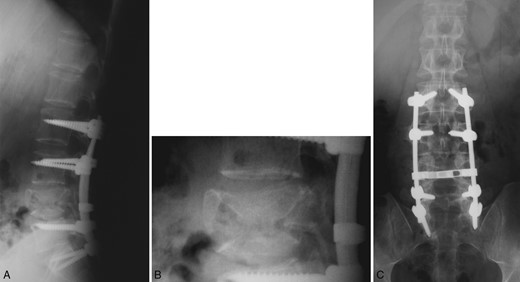 Postoperative plain radiograph of the lumbar spine following L2 to S1 posterior instrumention at 15 months. Good bony fusion is documented at the fractured vertebra with no signs of instrumentation failure.
