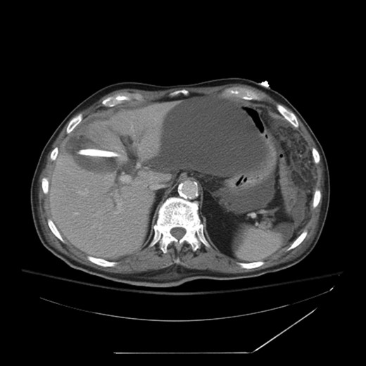 CT showing large biloma and intrahepatic biliary dilatation. Percutaneous drain visible in the gallbladder fossa.