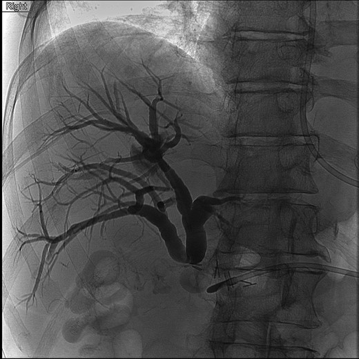 Cholangiogram of right intrahepatic ducts with abrupt cutoff at surgical clips.