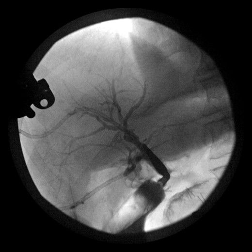 Intraoperative cholangiogram of the right ductal system through the extrahepatic right CBD.