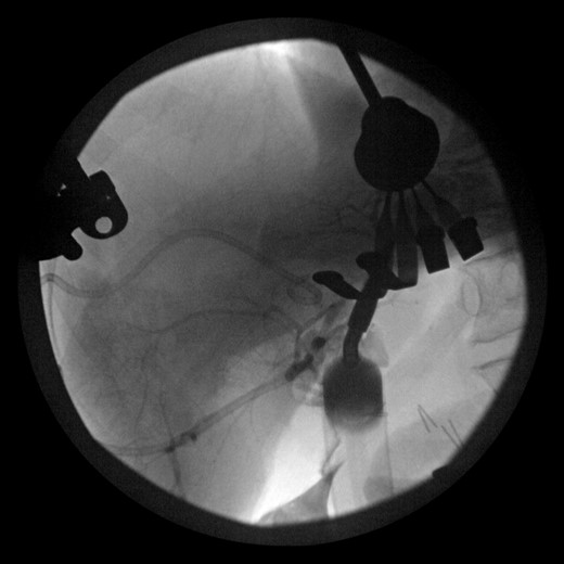 Intraoperative cholangiogram of the left ductal system through the extrahepatic left CBD.