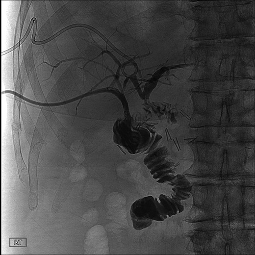 Postoperative cholangiogram with two separate hepaticojejunostomy anastomoses of the right and left intrahepatic bile ducts.