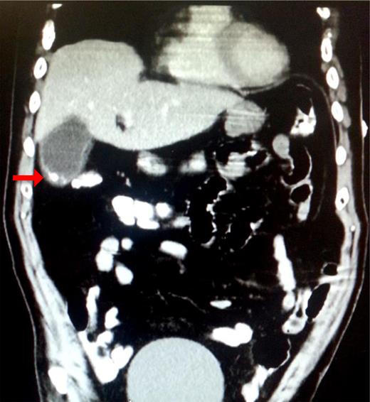 Mural calcification and/or stone in the fundus of the gallbladder (red arrow).