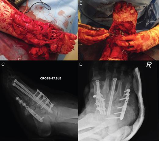 Open 3C Gustilo–Anderson injury. (A and B) Theatre images of open 3C Gustilo–Anderson fracture. (C and D) Radiographs illustrating open reduction internal fixation (ORIF) (screw fixation of the first and third metatarsals into the talus). The ORIF using cannulated screws allowed restoration of the medial and middle columns of the foot. Plate fixation of the medial and lateral column was conducted to achieve additional stability.
