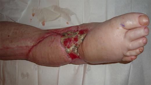 Flap failure on dorsal aspect of foot when patient presented after failed vacuum-assisted closure treatment.