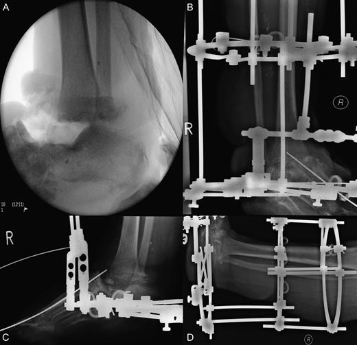 Surgical images of talectomy and external fixation used for tibiocalcaneal arthrodesis. (A) Anterior posterior intraoperative radiograph illustrating talectomy. (B–D) Radiographs showing external fixation in situ.